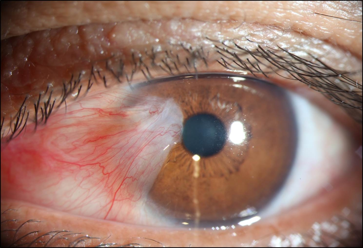 Pterígio (Foto: SES/SE)