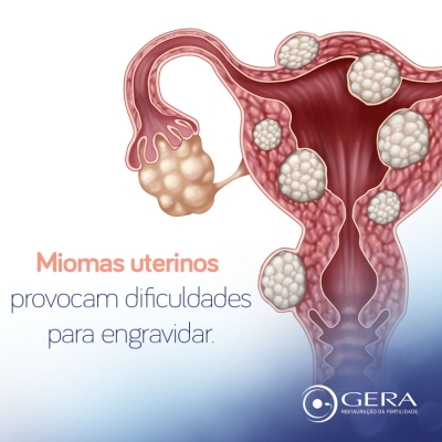 Mioma X Fertilidade: quando os miomas comprometem a fertilidade? (Imagem: Assessoria Clínica Gera)