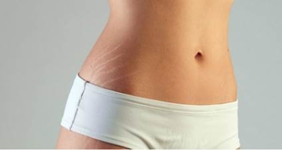 Tratamento de estrias nos dias mais quentes é possível, mas requer cuidado redobrado (Foto ilustrativa: Via Equipe Contato Comunicação & Marketing)