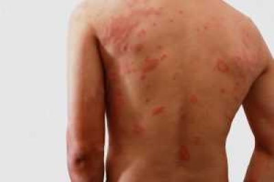 Hanseníase: doença silenciosa e infectocontagiosa que pode causar incapacidades físicas graves (Foto: SES/SE)