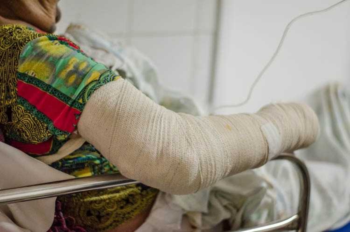 Cirurgiã plástica esclarece sobre o que pode ou não em caso de queimadura (Foto: SES/SE)