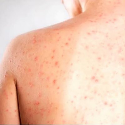 Saúde Estadual reforça a importância de estar imunizado contra o Sarampo (Foto: SES/SE)