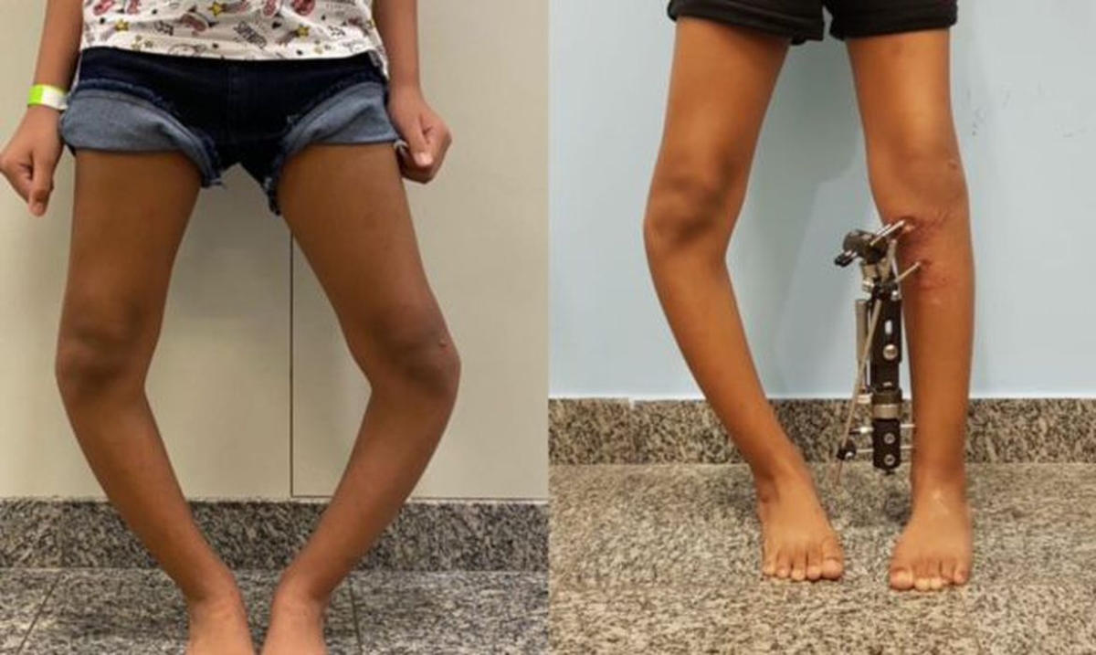 Técnica inovadora corrige deformidades nas pernas de crianças e jovens (Foto: Divulgação/ Instituto Nacional de Traumatologia e Ortopedia)