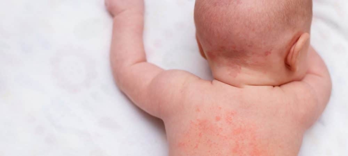 Surto de roséola em bebês aumentou durante a pandemia, aponta estudo (Foto: Olhar Digital)
