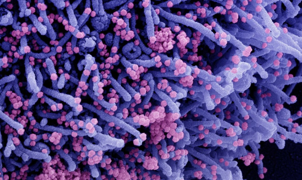 Micrografia eletrônica de varredura colorida de uma célula infectada com uma cepa variante de partículas do vírus SARS-CoV-2 (laranja), isolada de uma amostra de paciente (Imagem: National Institute of Allergy and Infectious Diseases/ NIAID)