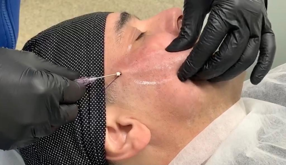 Fios de sustentação para o rosto são aliados no combate à flacidez facial (Foto: Divulgação)