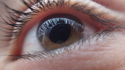Ceratocone: conheça a doença ocular que pode levar a um transplante de córneas (Foto: Assessoria Unimed Sergipe | AG? - Comunicação Estratégica)