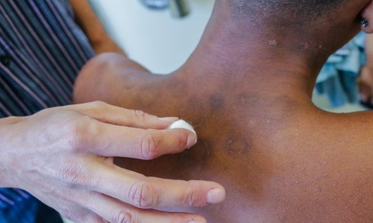 Pandemia de covid-19 faz notificações de hanseníase caírem 57% em 2021 (Foto: SMS de Mesquita/ RJ)