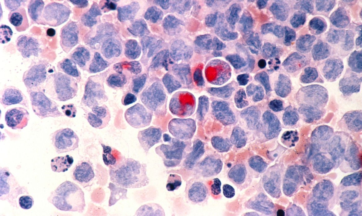 Anvisa aprova primeira terapia gênica contra câncer no Brasil (Foto: Instituto Nacional do Câncer/ Divulgação)