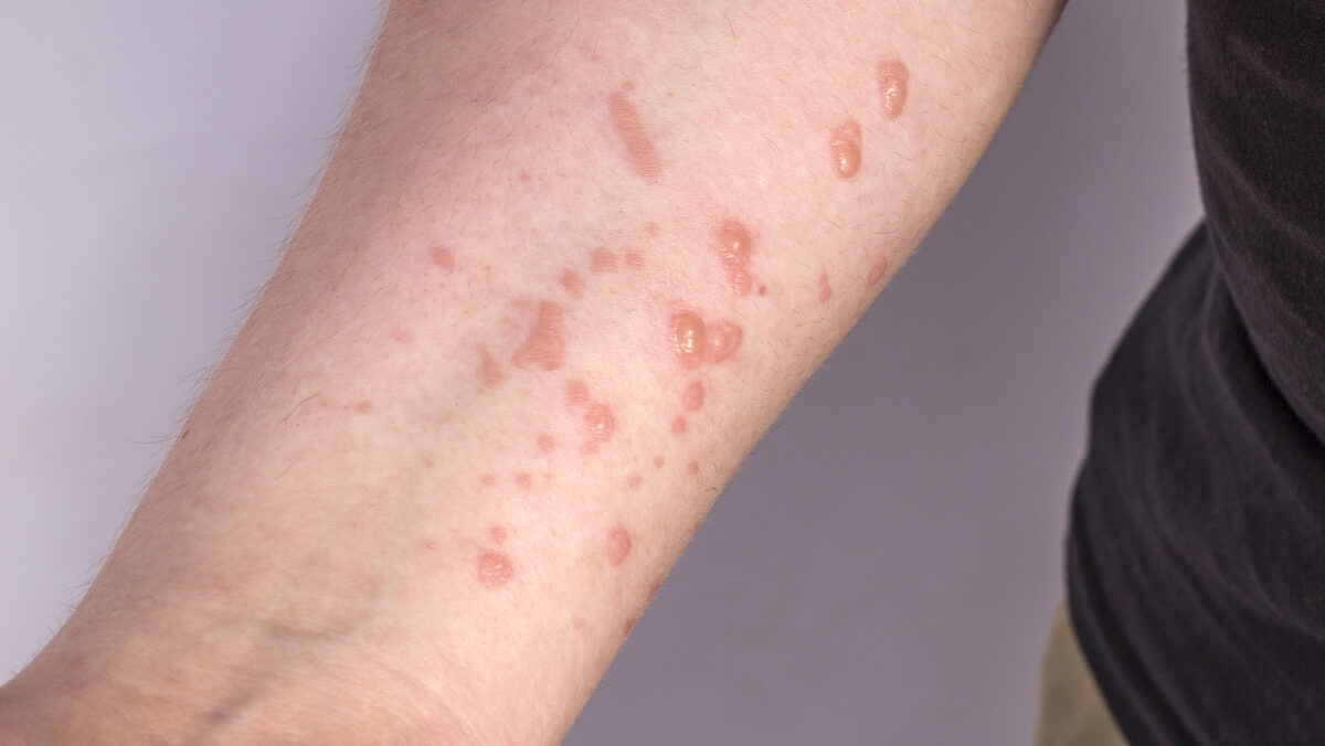 Saúde reforça junto a profissionais a importância da notificação dos casos de Monkeypox - Foto: Ascom SES/SE