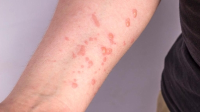 Sergipe registra mais um caso de Monkeypox - Foto: Ascom SES/SE