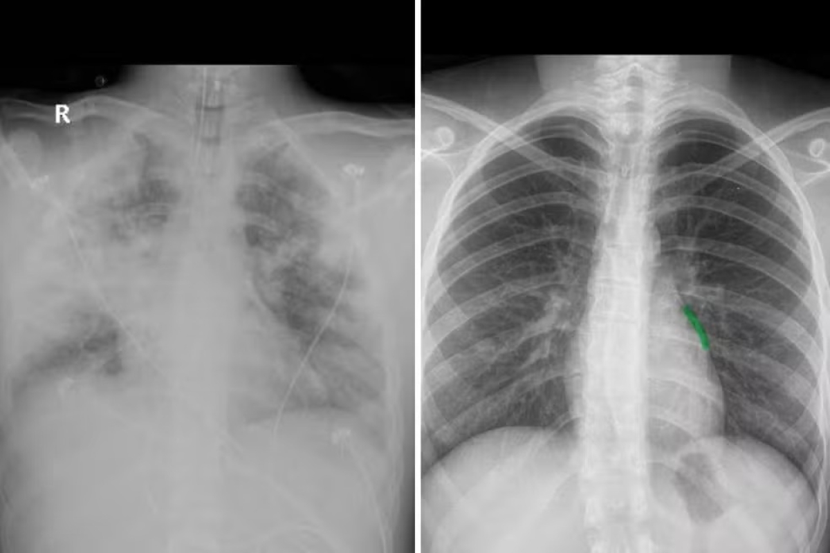 Do lado esquerdo, imagem do pulmão de Diego todo comprometido. Do lado direito, a imagem de um pulmão saudável - Foto: Divulgação