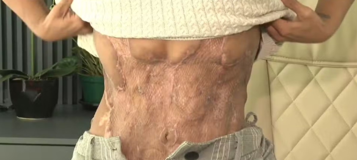 Letícia mostra como ficou após procedimento - Foto: Reprodução/NSC TV
